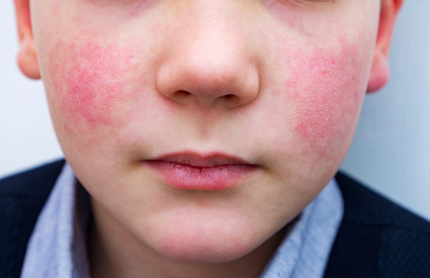 Photo of a child exhibiting the “slapped cheek” rash